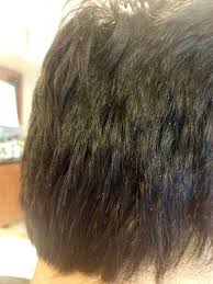 New insights into the pathogenesis and mechanism of hair loss. Dandruff Seborrheic Dermatitis Affects Hair Loss And Hair Transplants