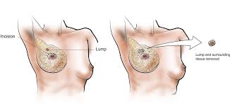 Besides lumps, many other signs and symptoms of breast cancer can help detect the condition. Lumpectomy Baylor Medicine