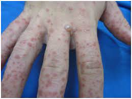 It mainly affects children especially during summer time, adults are not susceptible to get herpangina. Coxsackie A6 Infection Atypical Hand Foot Mouth Disease In The Us Military A Case Series