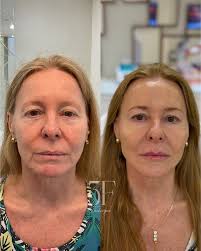 Franciely Follmann Boniatti| Harmonização Facial (@dra.franfollmann) •  Instagram फोटोहरू र भिडियोहरू