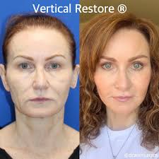 Welcome to an amazing Vertical Restore Journey! This patient has been  documenting her journey since day one, and now she has hit her 9 month  mark! It is so fun to watch