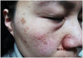 Image result for Solar Lentigo