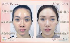 童顏針：與玻尿酸有何不同？最新一代精靈針爆點揭秘！- nhau