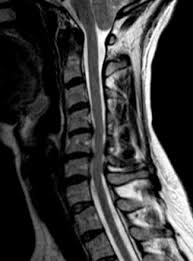 Στένωσις, contraído) es un término utilizado para denotar la constricción o estrechamiento de un orificio o conducto corporal. Estenosis Del Canal Vertebral Institut Chiari Siringomielia Escoliosis De Barcelona