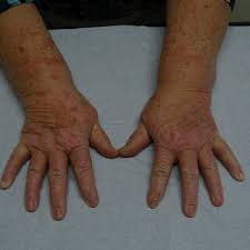 Image result for Photodermatitis