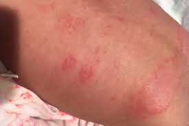 A Bilateral Itchy Rash Clinical Advisor