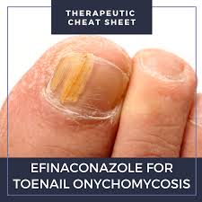 Image result for onychomycosis