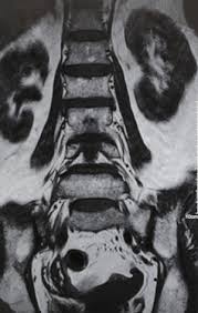 Image result for Low Back Imaging