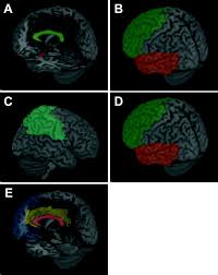 Asperger's syndrome acts as a typical example. Structural Mri In Autism Spectrum Disorder Pediatric Research