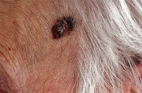 Just because dogs have fur doesn't mean they are immune to skin cancer. Basal Cell Carcinoma Knowledge Amboss