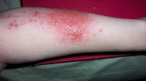 It cannot survive continuous direct sunlight so you will most often find it wrapped around trees where some shade is guaranteed and prospects for climbing are good. Poison Ivy Rash Pictures Remedies Prevention More