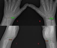 Image result for Scapholunate Dislocation