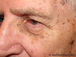 A blackhead is also called an open comedo (single for comedone), and it is a clogged pore in the skin that is open to the air. Favre Racouchot Syndrome American Osteopathic College Of Dermatology Aocd