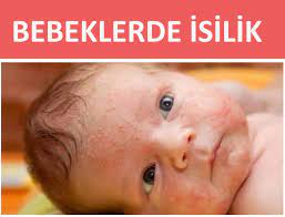 bebeklerde cocuklarda isilik