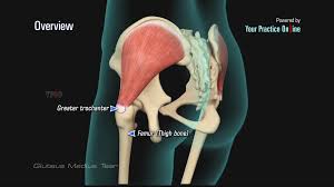 The band originates at the lateral iliac crest and extends distally to the patella, tibia, and biceps the iliotibial band is a thick band of fascia that extends along the lateral thigh from the iliac crest to the knee. Gluteus Medius Tear Video Medical Video Library