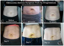 What To Expect During Umbilical Hernia Surgery Recovery Umbilical Hernia Umbilical Hernia Repair Hernia Repair