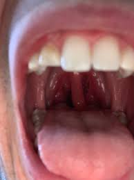 Why is my uvula swollen and red? Swollen Uvula Album On Imgur