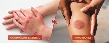 Image result for ringworm