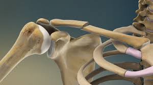 Severe cases may require surgery. Clavicle Fractures Johns Hopkins Medicine