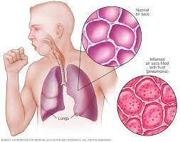 Pneumonia - Symptoms And Causes - Mayo Clinic