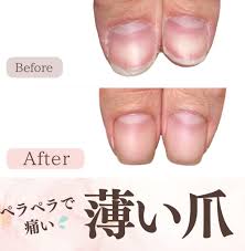 爪 薄い 痛い