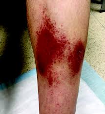 A child with hsp may also have joint pain, abdominal pain, and/or kidney problems. Keys To Differentiating Violaceous Discoloration On The Lower Legs And Feet Podiatry Today