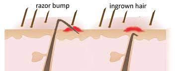 When you shave, the free edge of the hair is cut below the surface of the skin. What Causes Razor Bumps Vaderma Laser Hair Removal