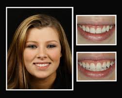 Besides reshaping and contouring your gums, you can also work on your teeth to bring back your. Laser Dentistry Roslyn Ny Gum Contouring Roslyn