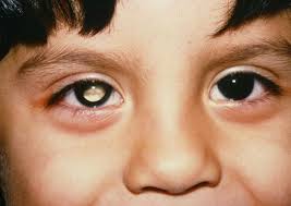 Likelihood of Germline Mutation with Solitary Unilateral Retinoblastoma  Based
