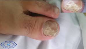 M., aspenwall r., thomson p. Nail Disorders In Patients With Chronic Renal Failure