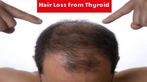Shifts in hormones can change the availability of nutrients and disrupt the hair's natural cycle, causing breakage, slowed growth, and even loss. Hair Loss And Thyroid Treatments To Combat Thyroid Induced Hair Loss Ak Clinics