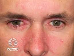 Image result for Seborrheic Dermatitis