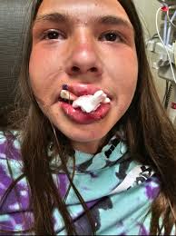 BMX rider suffers tricep injury in east Tennessee crash