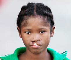 Your support of our work has created so much more than new smiles: It has  created hopeful and brighter futures. In #Madagascar, Philipine faced years  of teasing and insecurity due to her #