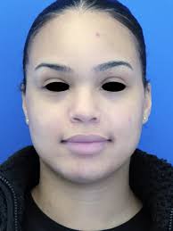 Narrow Nasal Base and Sill 6226