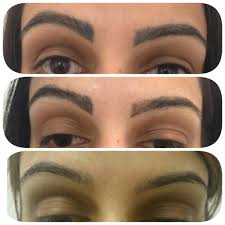 How does permanent makeup removal work? Tattoo Eyebrow Removal Before And After Lorena Oberg
