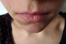 How To Get Rid Of Painful Cracked Lips Beauty Area Dry Lips Chapped Lips Remedy Pimple Treatment