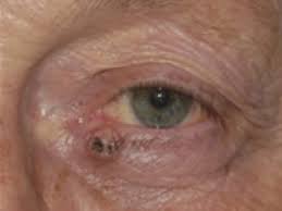 What patients and caregivers need to know about. Basal Cell Carcinoma Bcc Eyelid Cancer
