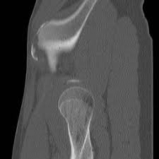 A pelvic avulsion fracture occurs when a part of a hip bone breaks and tears away. Avulsion Fractures Of The Pelvis In Adolescents Eurorad
