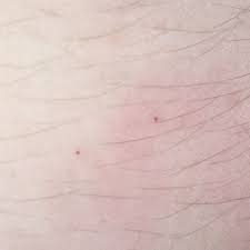 Kleine Rote Punkte Auf Meinem Ganzen Arm Menschen Blut Gesund