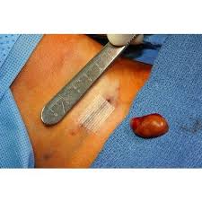 Kidney Stones Removal Treatment Kidney Treatment Service Siddha Skincare Center Chennai Id 9430318762