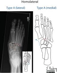 Even though travis etienne suffered a common football injury, it can become serious quickly. Lisfranc Injury Radiology Reference Article Radiopaedia Org