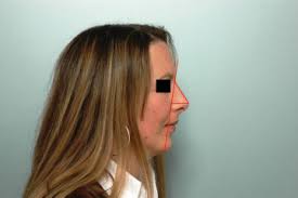 Nasal Tip Projection: Nuances in Understanding, Assessment, and Modification