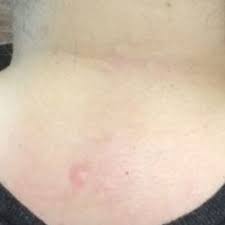 Here are some zip codes with the highest amounts of indianapolis city (balance) has 50 leaf removal and related companies to help you find the right professional for your leaf removal project. Laser Tattoo Removal Indianapolis In Removery