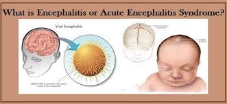 The most common type of brain tumor is a. Encephalitis Chamki Fever Causes Symptoms And Treatment