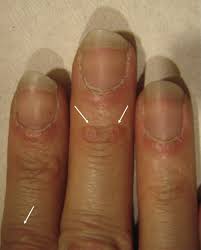 Image result for Muehrcke Line