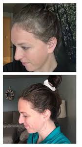 Post Partum Hair Growth Products In 2020 Postpartum Hair Loss Hair Loss New Hair Growth
