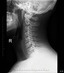 Please understand that our phone lines must be clear for urg. Normal Cervical Spine Radiographs Radiology Case Radiopaedia Org