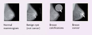 On a mammogram, breast cancer can look like a mass or angry star with spicules/spikes emanating from it. Breast Changes And Conditions National Cancer Institute