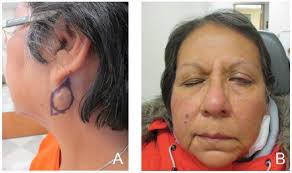 Acute, Temporary, Unilateral Facial Nerve Palsy After Dermatologic Surgery:  A Report of 3 Cases